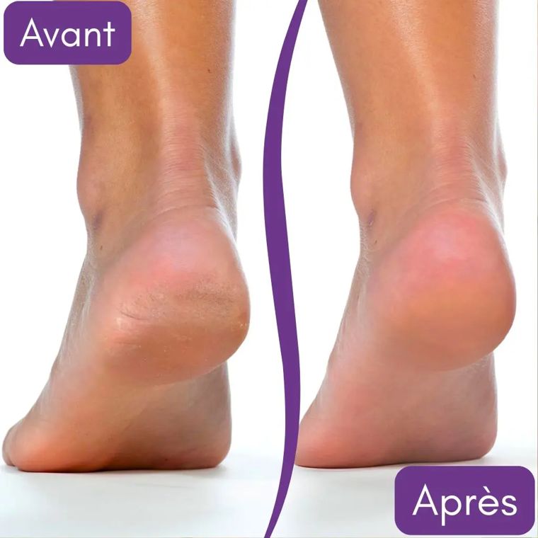 Photo avant-après d'un talon